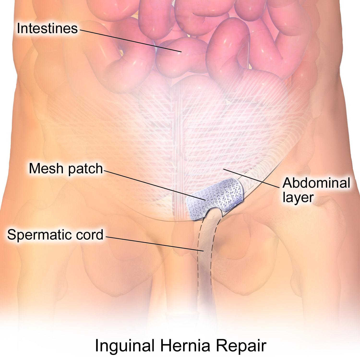 This image demonstrates the use of Hernia Mesh which can cause complications